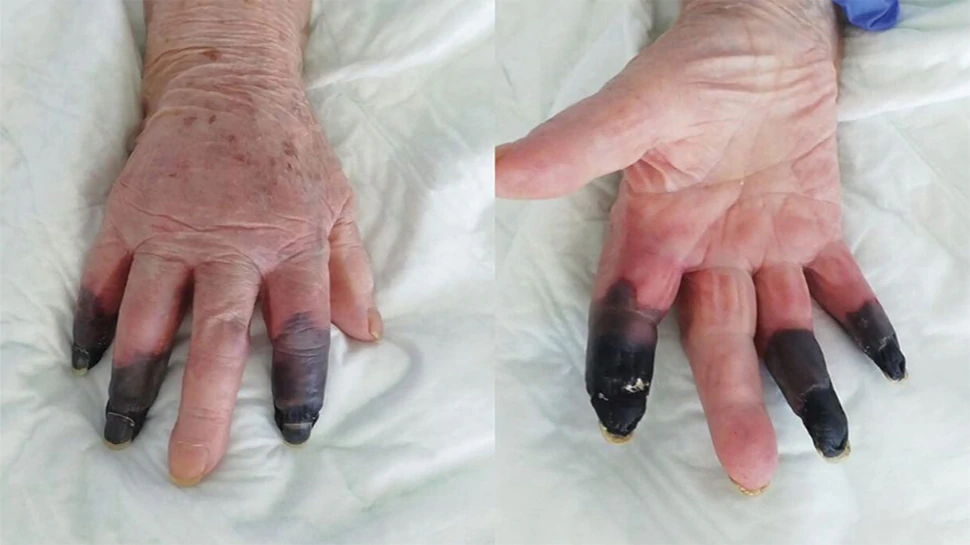 ظهور-شكل-خطير-آخر-من-أشكال-كورونا-…-امرأة-تبلغ-من-العمر-86-عاما-تصاب-بالغرغرينا-وتعين-قطع-ثلاثة-أصابع